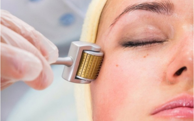 Microagulhamento facial